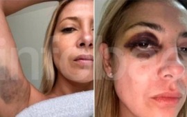 Imagen de Fotos de Fabiola Y&aacute;&ntilde;ez con moretones refuerzan la denuncia contra Alberto Fern&aacute;ndez
