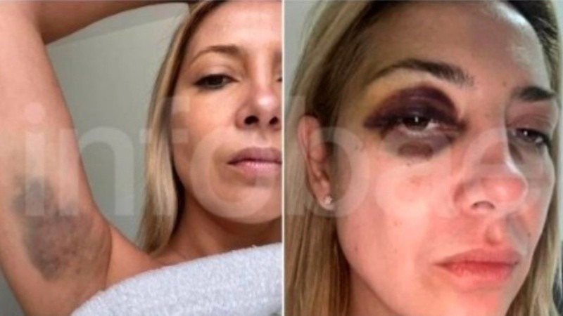 Imagen de Fotos de Fabiola Y&aacute;&ntilde;ez con moretones refuerzan la denuncia contra Alberto Fern&aacute;ndez