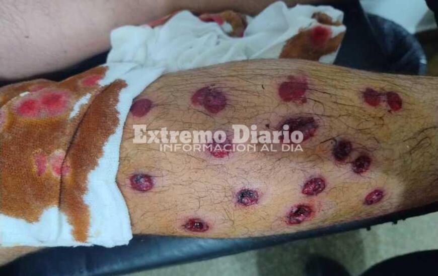 Impactante. Así le quedó la pierna a uno de los chicos