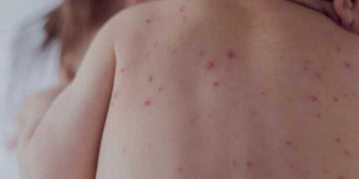 Se puso en marcha un protocolo de vigilancia intensificada