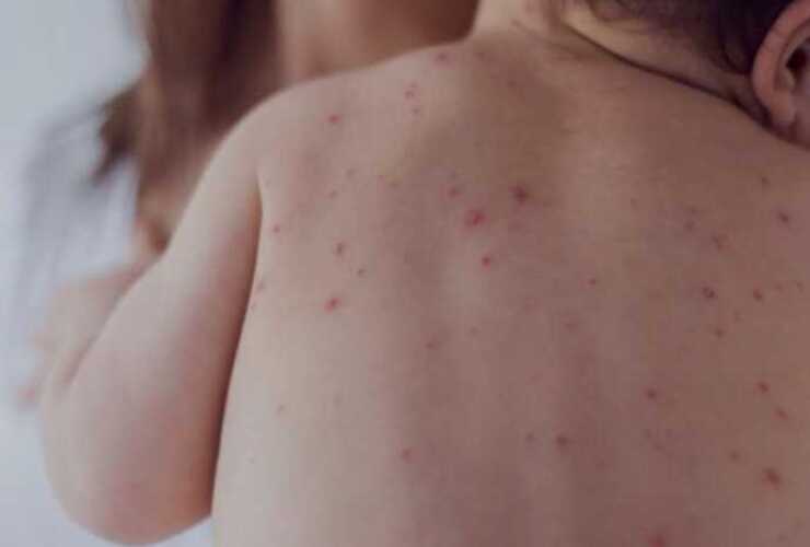 Se puso en marcha un protocolo de vigilancia intensificada