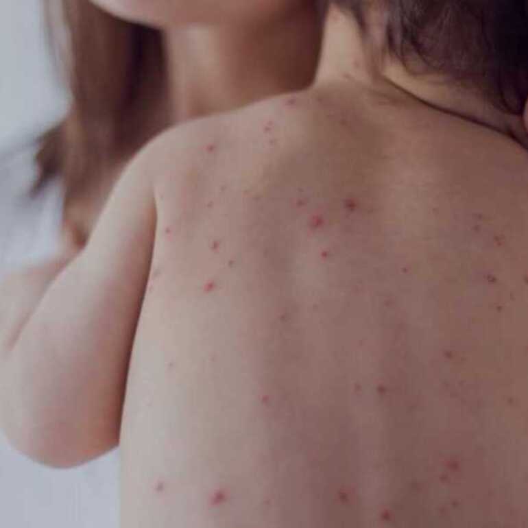 Se puso en marcha un protocolo de �vigilancia intensificada�