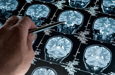 Imagen de Esperanza contra el Alzheimer: Cient&iacute;ficas del Conicet desarrollan una prometedora terapia experimental