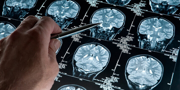 Imagen de Esperanza contra el Alzheimer: Cient&iacute;ficas del Conicet desarrollan una prometedora terapia experimental