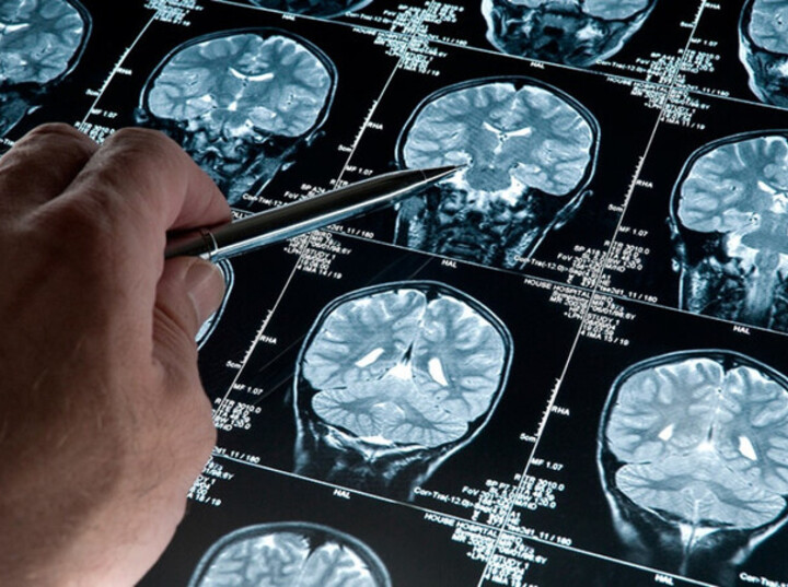 Imagen de Esperanza contra el Alzheimer: Cient&iacute;ficas del Conicet desarrollan una prometedora terapia experimental