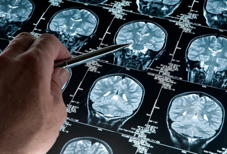 Imagen de Esperanza contra el Alzheimer: Cient&iacute;ficas del Conicet desarrollan una prometedora terapia experimental