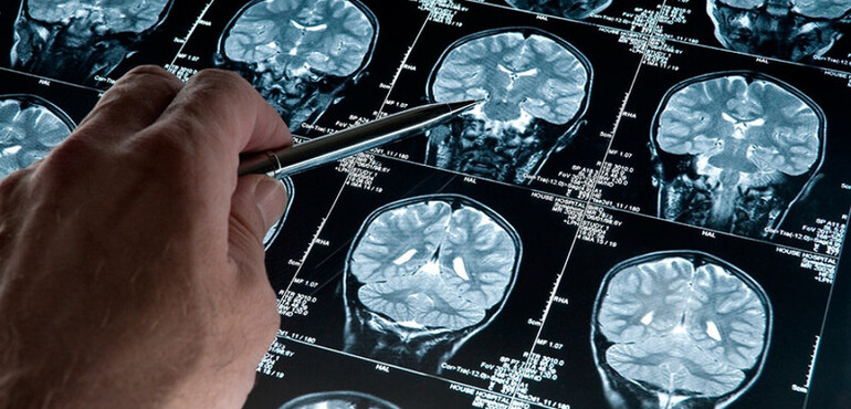 Imagen de Esperanza contra el Alzheimer: Cient&iacute;ficas del Conicet desarrollan una prometedora terapia experimental