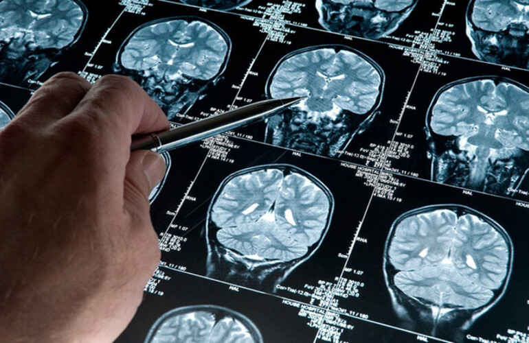 Imagen de Esperanza contra el Alzheimer: Cient&iacute;ficas del Conicet desarrollan una prometedora terapia experimental