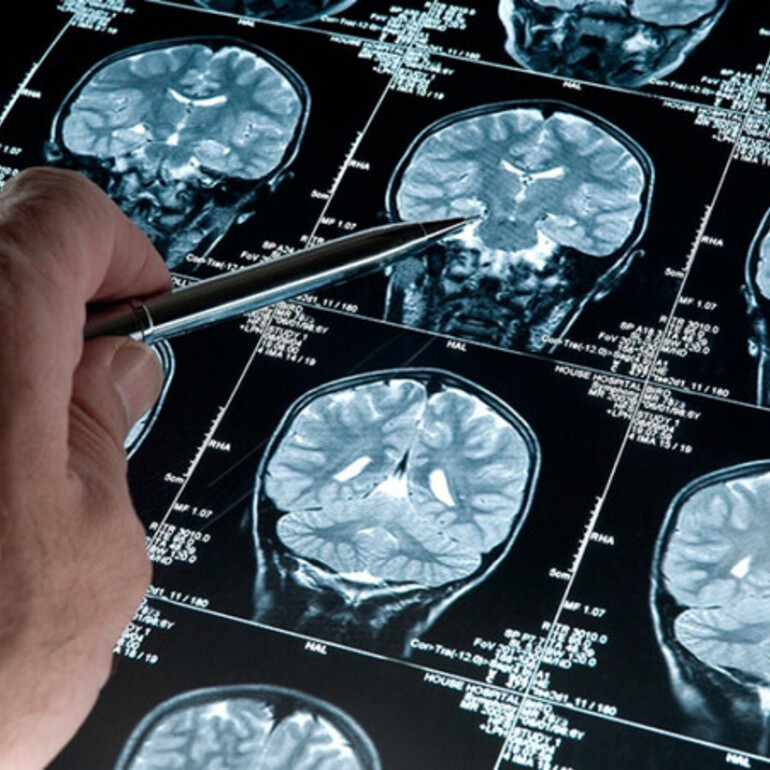 Imagen de Esperanza contra el Alzheimer: Cient&iacute;ficas del Conicet desarrollan una prometedora terapia experimental