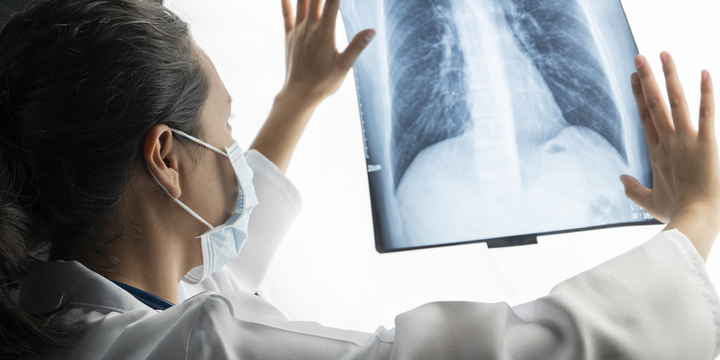 Imagen de Alerta sanitaria: la tuberculosis, una enfermedad antigua que recobra fuerza en la regi&oacute;n