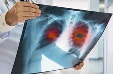 Imagen de Alerta sanitaria: los casos de tuberculosis aumentaron un 80% en los &uacute;ltimos cinco a&ntilde;os