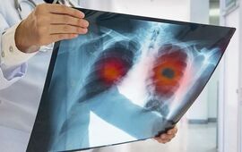Imagen de Alerta sanitaria: los casos de tuberculosis aumentaron un 80% en los &uacute;ltimos cinco a&ntilde;os