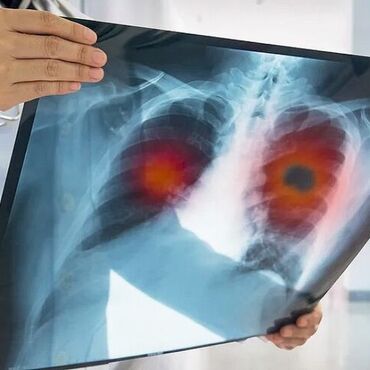 Imagen de Alerta sanitaria: los casos de tuberculosis aumentaron un 80% en los &uacute;ltimos cinco a&ntilde;os