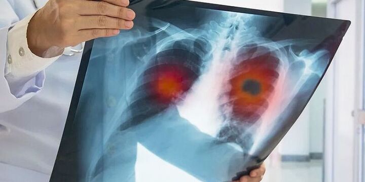 Imagen de Alerta sanitaria: los casos de tuberculosis aumentaron un 80% en los &uacute;ltimos cinco a&ntilde;os