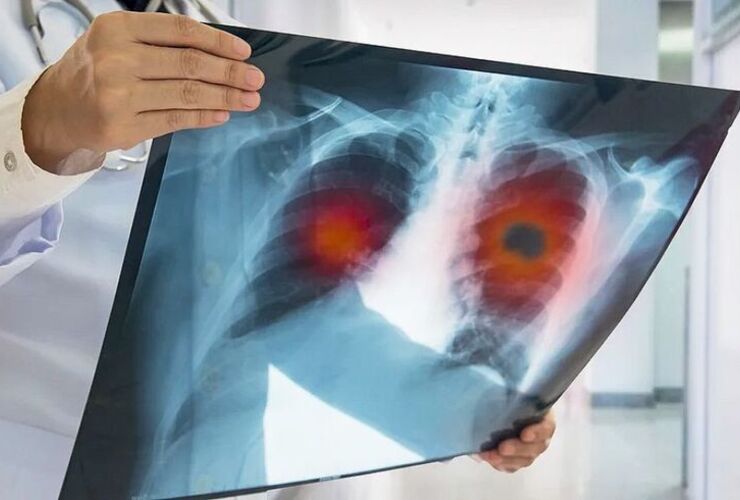 Imagen de Alerta sanitaria: los casos de tuberculosis aumentaron un 80% en los &uacute;ltimos cinco a&ntilde;os