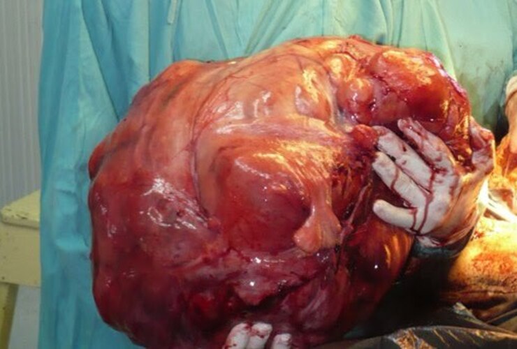 Imagen de Extirparon un tumor de 25 kilos en un hospital bonaerense