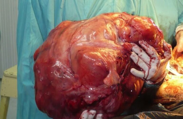 Imagen de Extirparon un tumor de 25 kilos en un hospital bonaerense