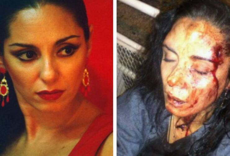 Imagen de Bailarina sufrió una brutal golpiza de su expareja