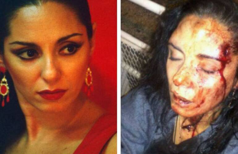 Imagen de Bailarina sufri&oacute; una brutal golpiza de su expareja