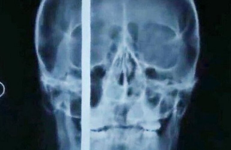 Imagen de Incre&iacute;ble: sobrevive despu&eacute;s de que un palo le atraviesa la cabeza