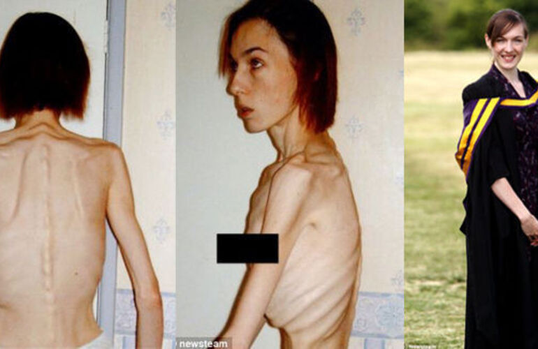 Imagen de Caso llamativo: pesaba 30 kilos y cre&iacute;an que morir&iacute;a; hoy termin&oacute; la universidad