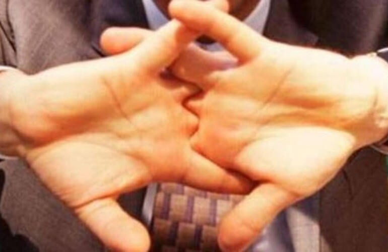 Imagen de Salud: ¿Crujirse los dedos da artritis?