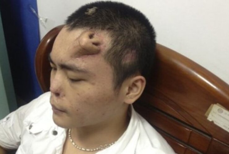 Imagen de China: Perdió la nariz en un accidente y se la reconstruyeron en la frente