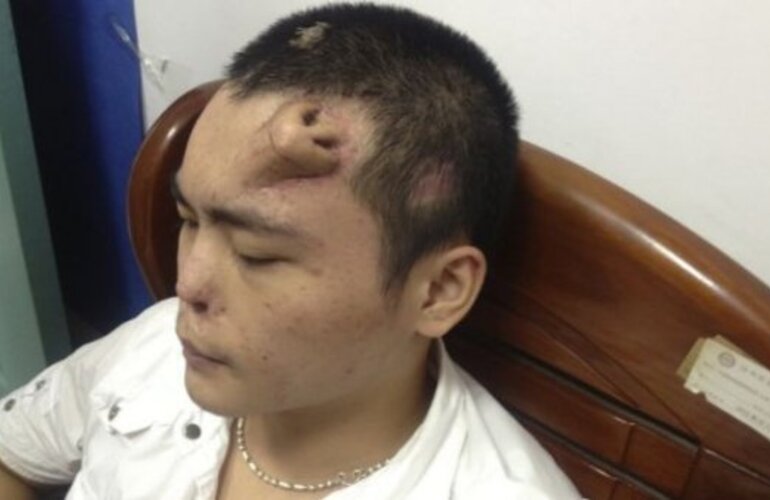 Imagen de China: Perdió la nariz en un accidente y se la reconstruyeron en la frente
