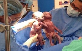 Imagen de En Estados Unidos dos bebés nacieron agarrados de la mano