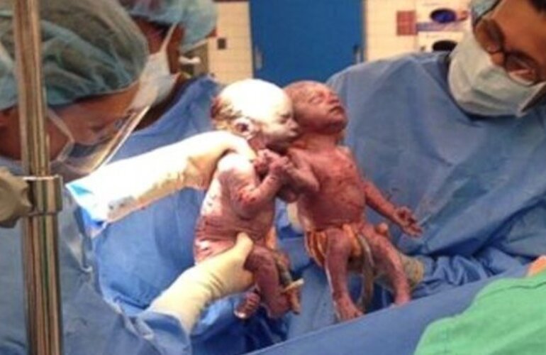 Imagen de En Estados Unidos dos beb&eacute;s nacieron agarrados de la mano