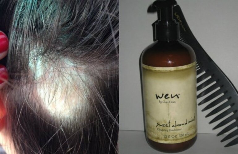 Denuncian a un estilista por vender un shampoo que provoca la caída del cabello