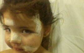 La nena recibi&oacute; 50 puntos de sutura en la cara y en la cabeza. Foto: @hbruscaglia