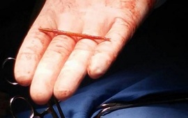 Escarbadientes encontrado en el medio del corazón