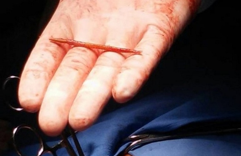 Escarbadientes encontrado en el medio del corazón