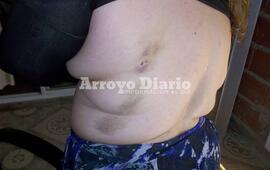 Las marcas todav&iacute;a en el cuerpo de la v&iacute;ctima.