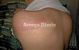 Marcas. Así le quedó la espalda a Gastón, tras ser atacado por uno de los violentos anoche en su casa.