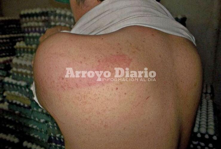 Marcas. Así le quedó la espalda a Gastón, tras ser atacado por uno de los violentos anoche en su casa.