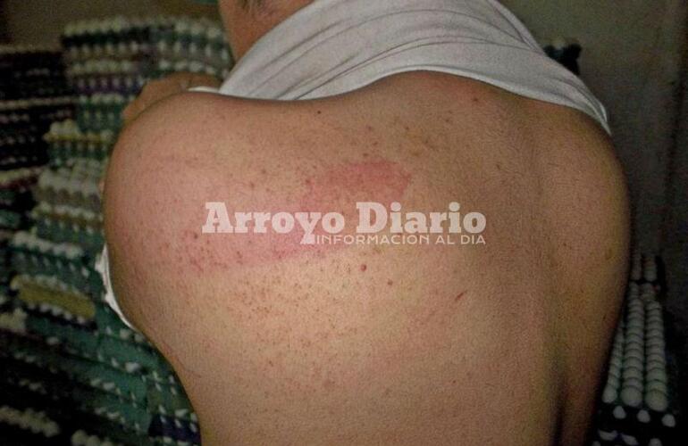 Marcas. Así le quedó la espalda a Gastón, tras ser atacado por uno de los violentos anoche en su casa.