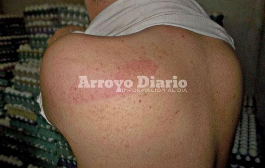 Marcas. As&iacute; le qued&oacute; la espalda a Gast&oacute;n, tras ser atacado por uno de los violentos anoche en su casa.
