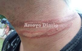 Así le quedó el cuello tras el incidente.
