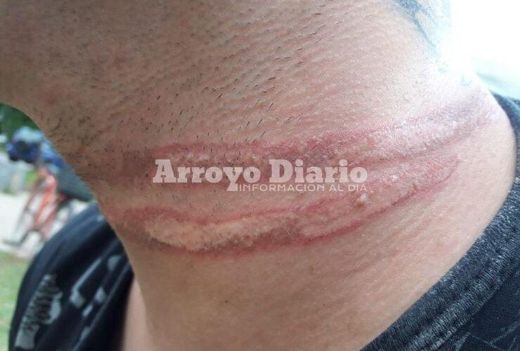 Así le quedó el cuello tras el incidente.