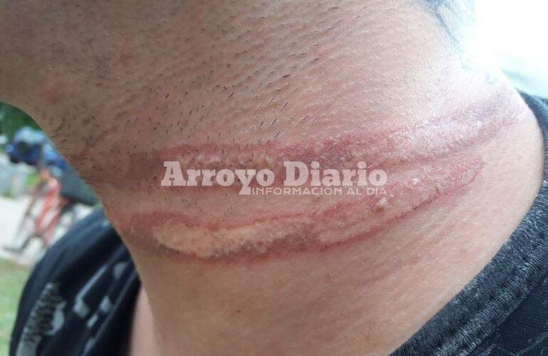 Así le quedó el cuello tras el incidente.