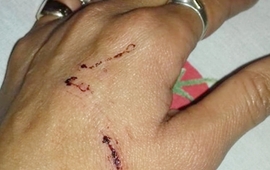 Lastimada. La joven fue herida con un arma blanca. Foto: Notilagos.