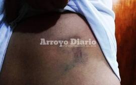 Hematoma. Una de las marcas que le dejó el delincuente a consecuencia de una de las patadas que le dio durante el forcejeo.