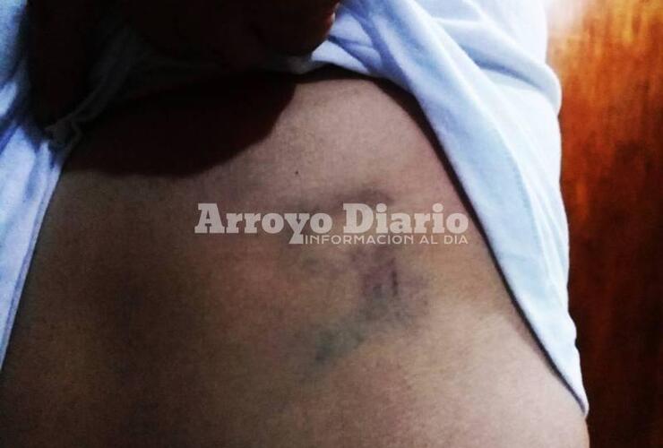 Hematoma. Una de las marcas que le dejó el delincuente a consecuencia de una de las patadas que le dio durante el forcejeo.