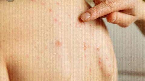 Imagen de Brote de Varicela en General Lagos