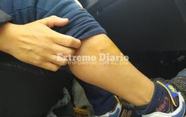 Imagen de La mordi&oacute; un perro cuando iba en moto