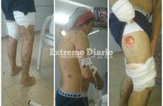 Imagen de Graves heridas reviste el joven lastimado con postas de goma por la policía