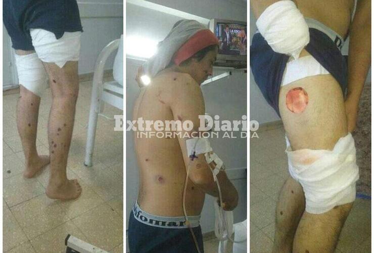 Imagen de Graves heridas reviste el joven lastimado con postas de goma por la policía