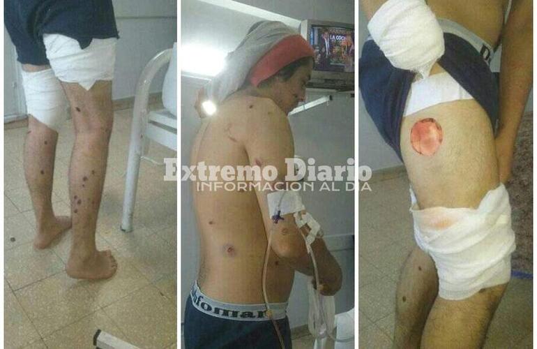 Imagen de Graves heridas reviste el joven lastimado con postas de goma por la policía